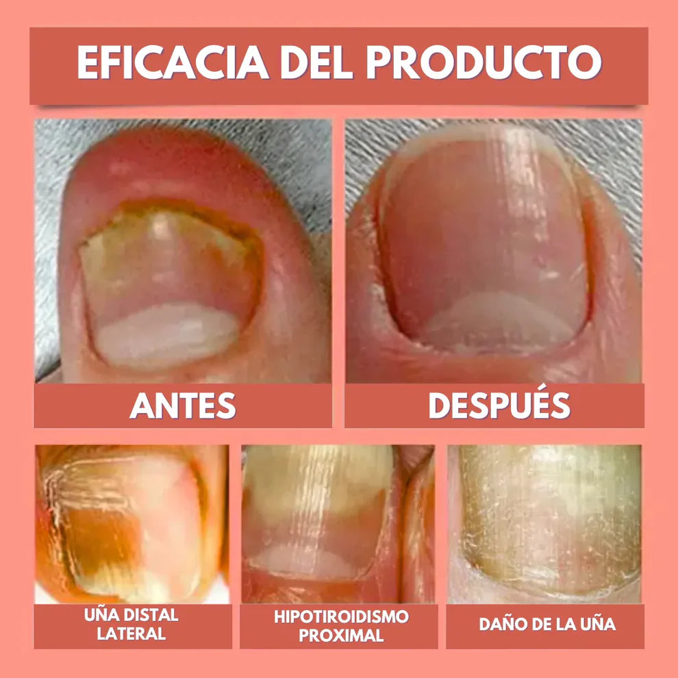 DermaPatch™ Parche Antifúngico para Hongo