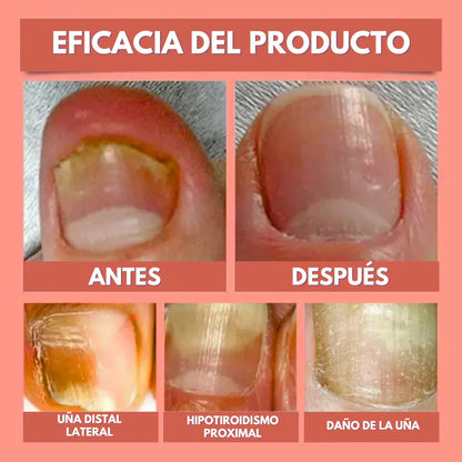 DermaPatch™ Parche Antifúngico para Hongo