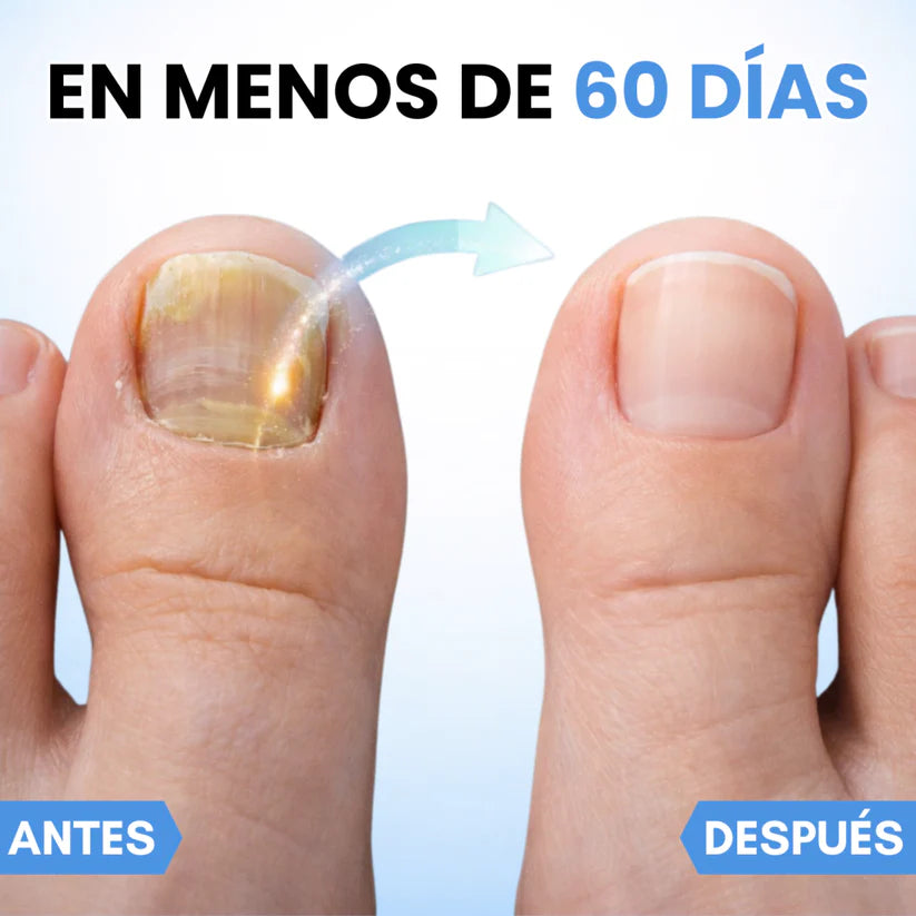 2x1  NailClear Pro™ – Parches Intensivos Antihongos para Uñas (32 Parches)
