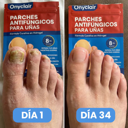 2x1  NailClear Pro™ – Parches Intensivos Antihongos para Uñas (32 Parches)