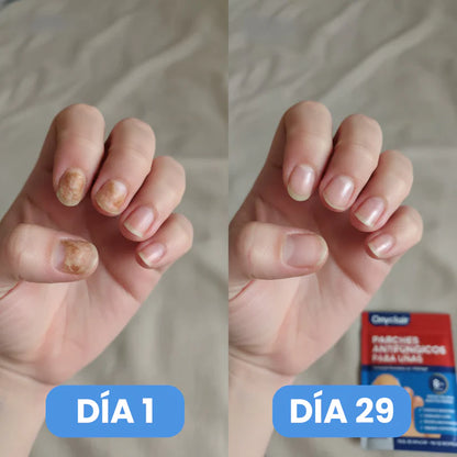2x1  NailClear Pro™ – Parches Intensivos Antihongos para Uñas (32 Parches)